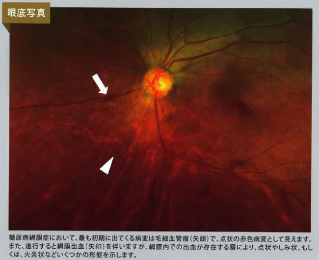 初期（単純網膜症）