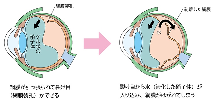 網膜剥離（横）