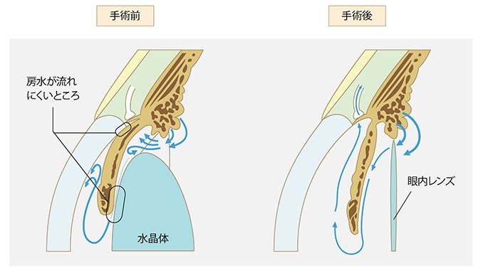 続発緑内障の白内障手術