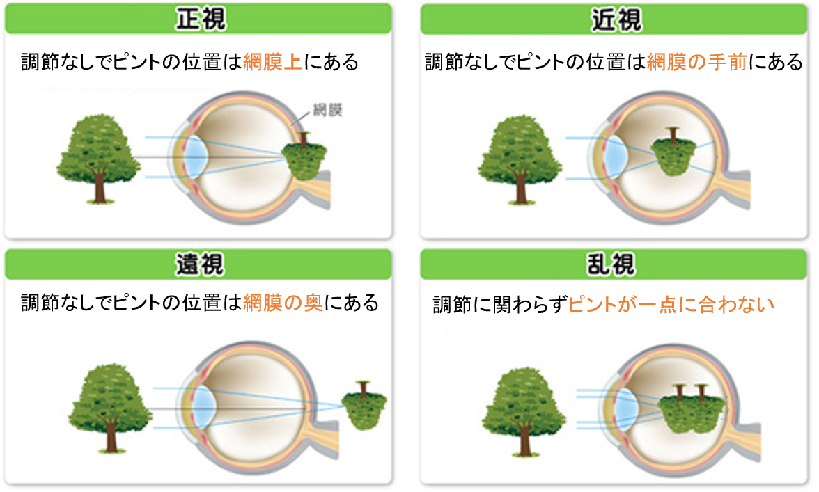 屈折異常とは